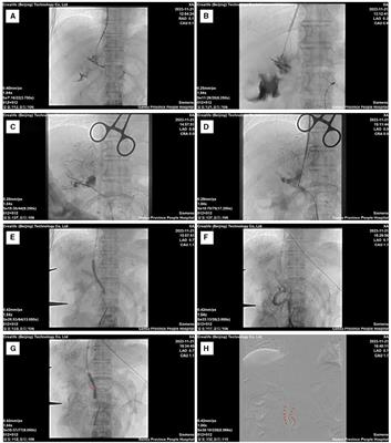 Case report: Management of liver cancer complicated by gastric varices rupture and bleeding: transjugular intrahepatic portosystemic shunt utilizing the mesenteric venous pathway